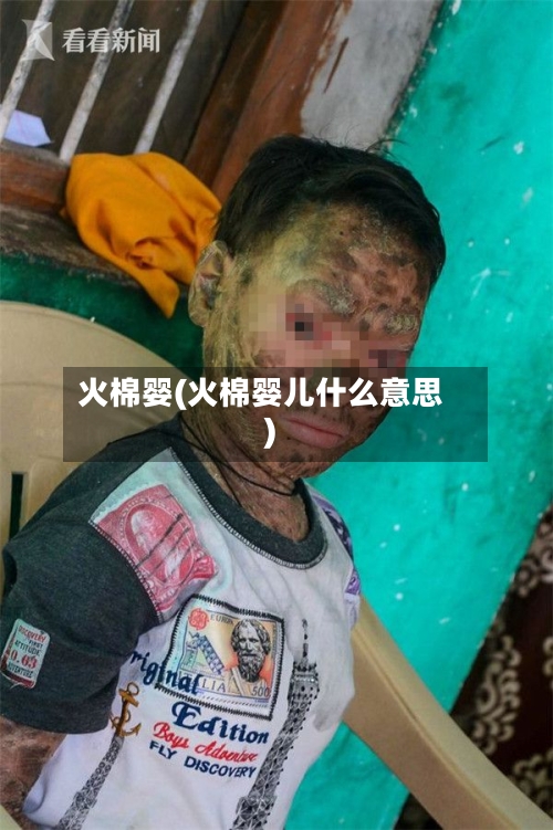 火棉婴(火棉婴儿什么意思)-第2张图片